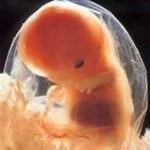 Aborto cirúrgico Aborto cirúrgico