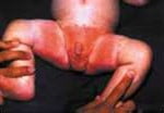 Dermatite das fraldas como dar alívio ao seu bebê