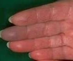 Doena de Raynaud Doença de Raynaud