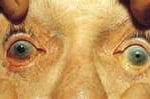 Glaucoma Glaucoma