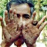 Hanseníase como se transmite