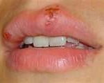 Herpes Herpes