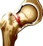 Osteoporose Males da Osteoporose
