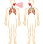 Tuberculose e gravidez Tuberculose e gravidez cuidados fundamentais