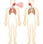 Tuberculose e gravidez cuidados fundamentais