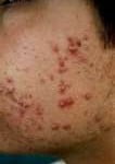 Acne Acne