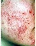 Acne Pesadelo de Adolecentes: Acne e Espinhas